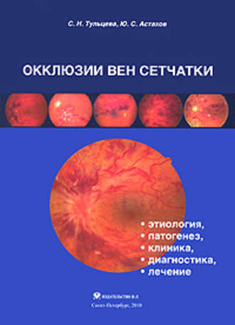 С. Н. Тульцева. Окклюзии вен сетчатки (этиология, патогенез, клиника, диагностика, лечение)