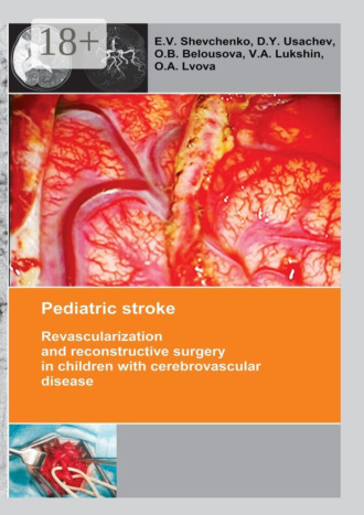 . Pediatric stroke. Revascularization and reconstructive surgery in children with cerebrovascular disease
