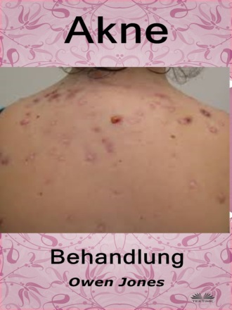 Оуэн Джонс. Akne-Behandlung