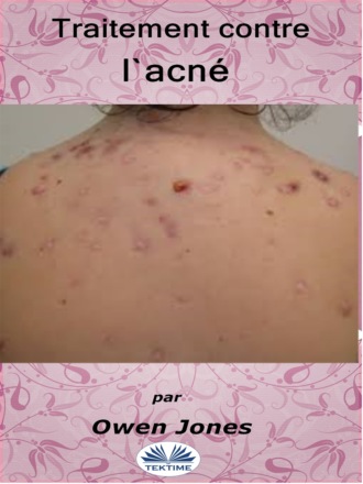 Оуэн Джонс. Traitement Contre L'Acné
