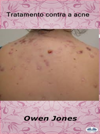 Оуэн Джонс. Tratamento Contra A Acne