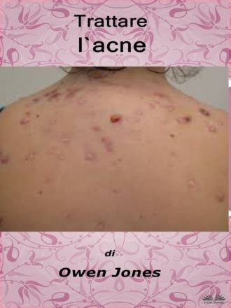 . Trattare L'Acne