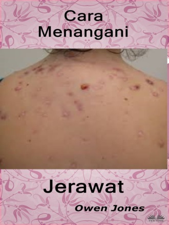 Оуэн Джонс. Cara Menangani Jerawat