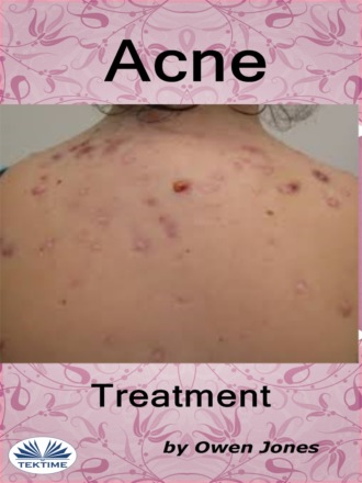 Оуэн Джонс. Acne Treatment