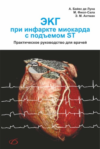 А. Байес де Луна. ЭКГ при инфаркте миокарда с подъемом ST