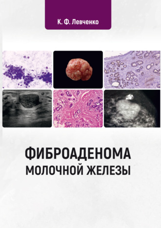 К. Ф. Левченко. Фиброаденома молочной железы